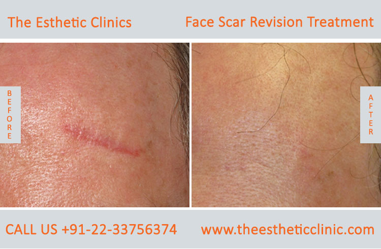 Facial Scars Revision laser Treatment for Face before after photos in mumbai india (6)